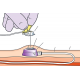 Cateter Totalmente Implantável para Quimioterapia